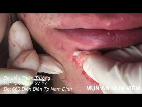 NẶN MỤN ẨN, MỤN MỦ VIÊM CHI CHÍT TRÊN KHUÔN MẶT