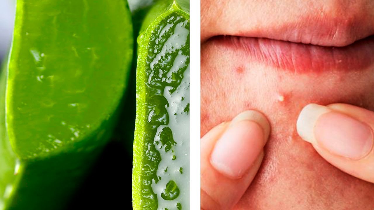 Como Usar la Sabila para Curar el Acne YouTube