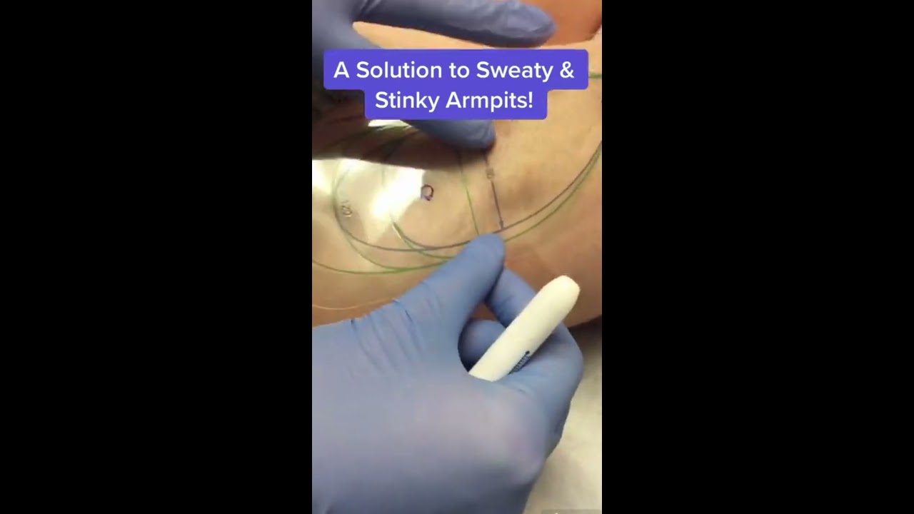 How To Get Rid Of Sweaty And Stinky Armpits Permanently MIRADRY Shorts