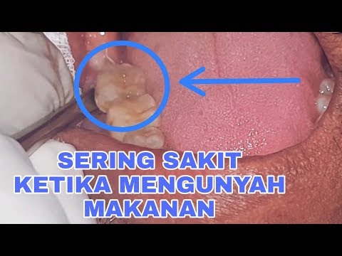 Dokter: Gejala Serangan Jantung Mirip Maag dan Nyeri Rahang - iNews Siang 19/02. 