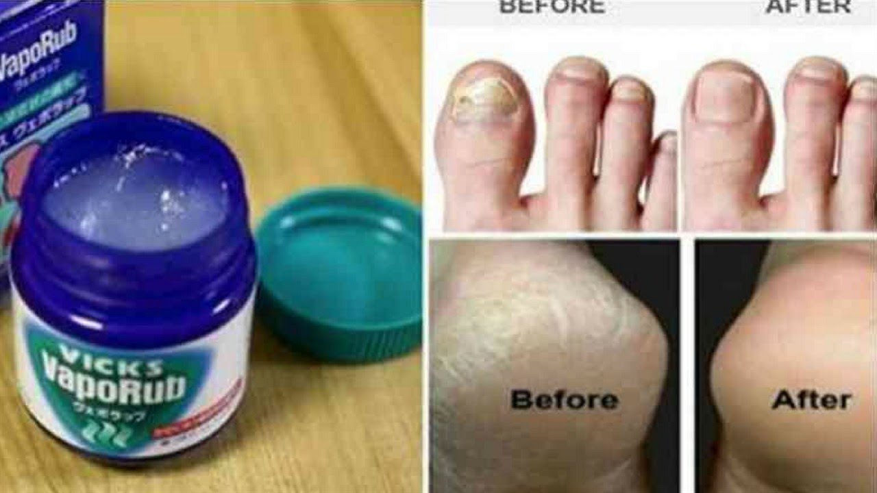 Vicks Vaporub Uses - Vicks Vapor Rub Uses