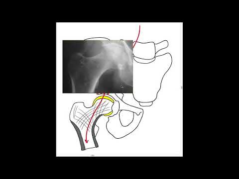 Vidéo: Fractures Fémorales Sous-trochantériennes Atypiques: Rôle Pour La Mécanique Et La Qualité Osseuse