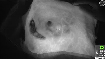 SPY PHI and SPY QP - Breast Reconstruction