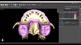Bone Reduction Guide Templates and Prosthetic Spacers Video