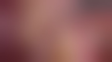 laparoscopic appendicectomy by Dr Pavan Addala