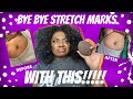 HOW TO GET RID OF STRETCH MARKS AT HOME!!!  | FT. DOSSIER