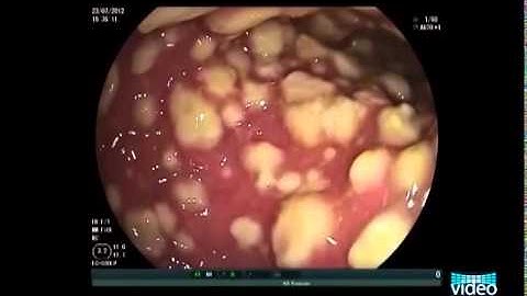 Endoscopic Imaging of Clostridium diffìcile Colitis