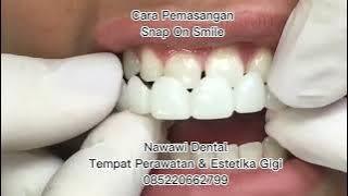 Cara Pemasangan Snap On Smile | Nawawi Dental