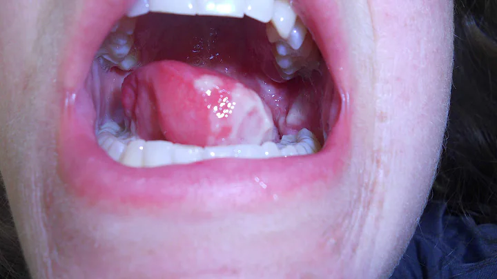 How to survive Tongue Cancer Radiation for Young P...