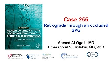 Case 255: Manual of CTO PCI - Retrograde through an occluded SVG