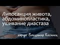 Липосакция живота, абдоминопластика, ушивание диастаза - хирург Владимир Косинец