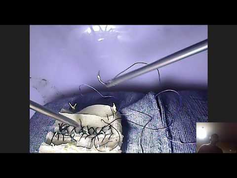 ლაპაროსკოპული კერვა და კვანძვა ერთი ნემსდამჭერით!