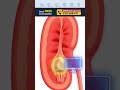 Kidney Stone कितने size पर Surgery जरूरी होती है? #shorts