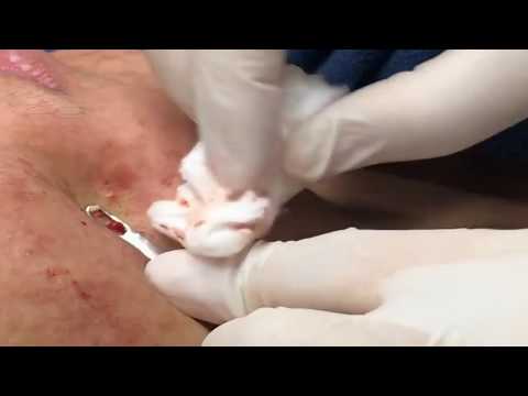 Milia Blackhead, Acne Extraction, Cystic Pimple,  And  Acne Treatment On Face ep