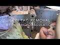 Skin tag removal