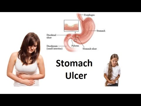 How to Avoid Irritating an Ulcer