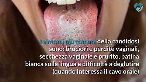 Come si cura la Candida del cavo orale?