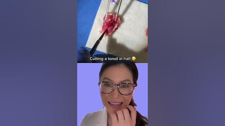 Cutting open a Tonsil to see all the Baby tonsil stones (don’t watch if dissection makes you sick)