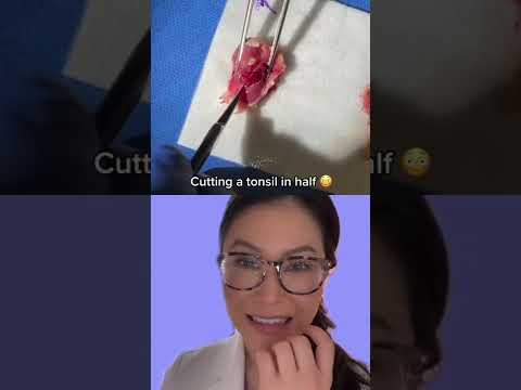 Cutting open a Tonsil to see all the Baby tonsil stones (don’t watch if dissection makes you sick)
