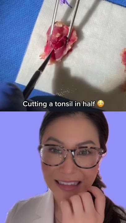 Cutting open a Tonsil to see all the Baby tonsil stones (don’t watch if dissection makes you sick)