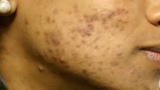 Moderate Resistant Acne Case Study