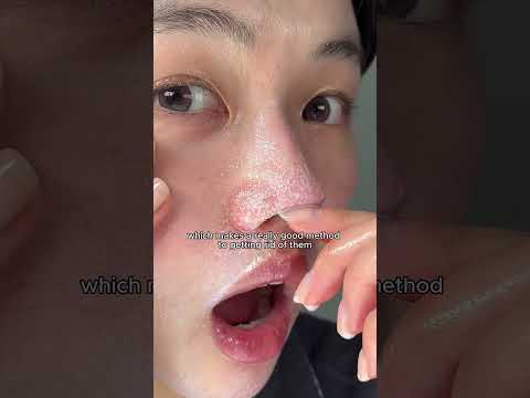 How To Get Rid Of Sebaceous Filaments And Blackheads Using The Orien Cleansing Oil And Wash 