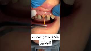 علاج عصب الاسنان || root canal treatment