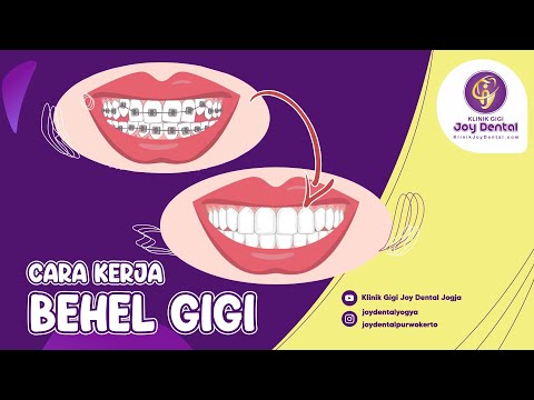 Video: Bagaimana cara kerja kawat gigi self ligating?