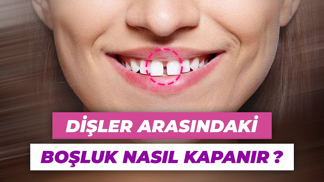 Dişler arasındaki boşluk nasıl kapanır?