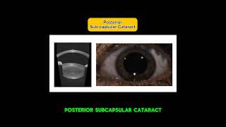 Posterior sub-capsular cataract with Alcon Vivity lens replacement #cataract