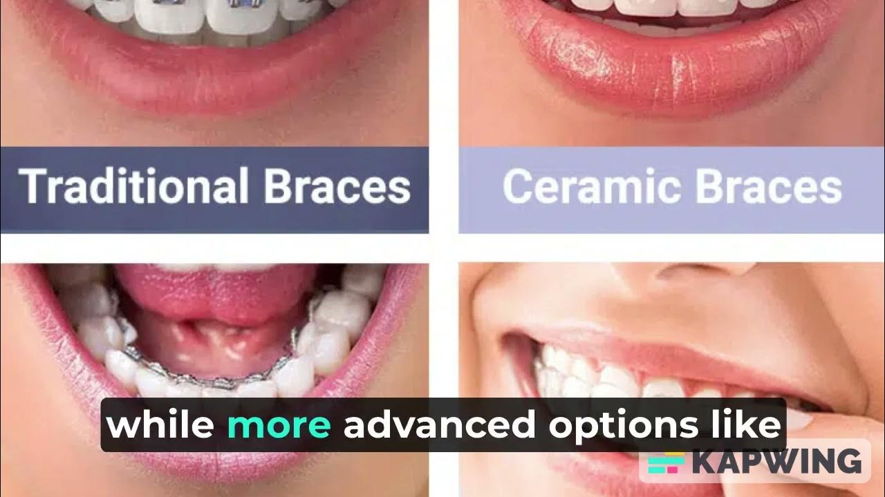 How much for Orthodontic Braces in Thailand in 2023 ? ထိုင်းနိုင်ငံမှာ