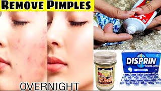 Three Ways to Remove Pimples Overnight  - 100% Instant Results - Acne Treatment #magicalacniremoval