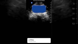 Auto Bladder Acquisition | Clinical Image