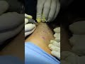 Hair transplant procedure by dr adarsh tripathi