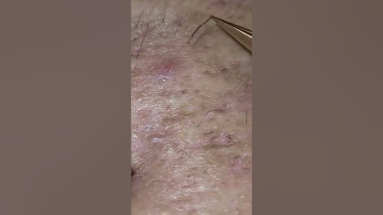 The Worst Gigantic Blackheads 2022 & Comedo Extraction YouTube