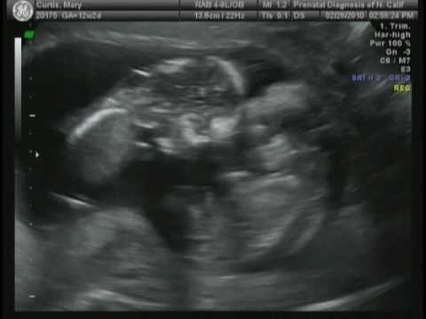 Identical Twins Ultrasound 13 Weeks - YouTube