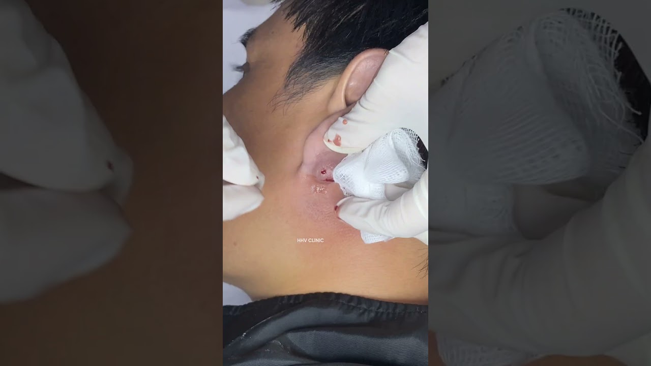 Nặn mụn u nang bã ở tai.