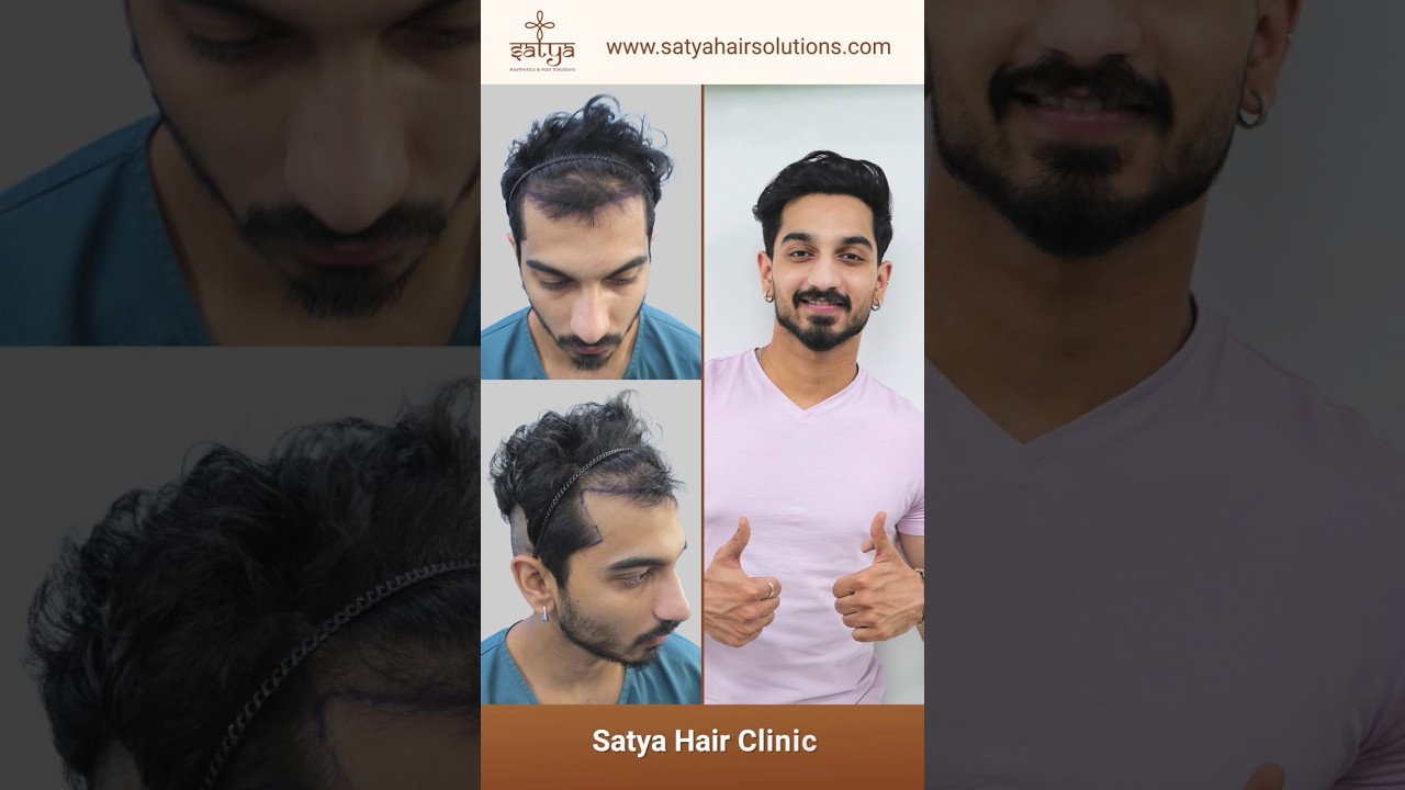 Hairline Transplant |Hairline Regrowth| Hair Loss | satya 