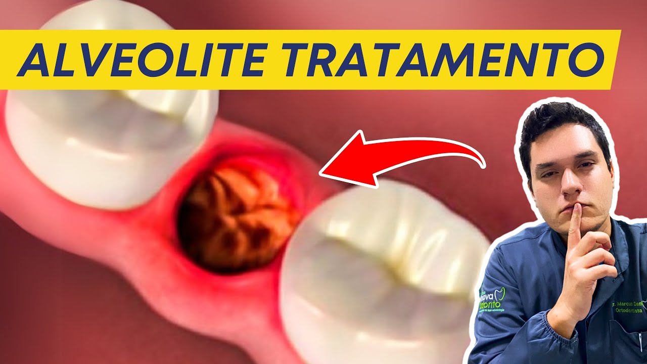 ALVEOLITE DENTÁRIA APÓS EXTRAÇÃO - COMO TRATAR? - YouTube