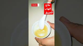 اسرع وصفه طبيعيه لعلاج الحروق بدون ما تترك اثر shrts