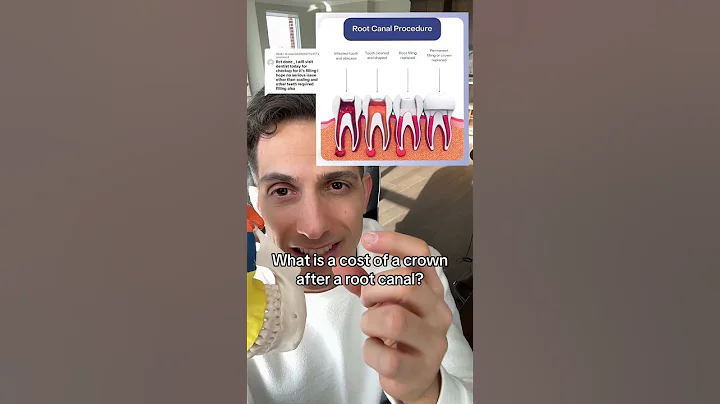 How Much Does a Crown Cost After a Root Canal?