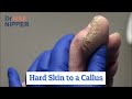 Hard Skin to a Callus [Thursday Throwback]