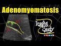 Adenomyomatosis of Gallbladder || Ultrasound || Case 198