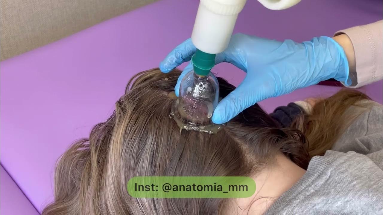 Лифтинг хиджама на лицо как выглядит