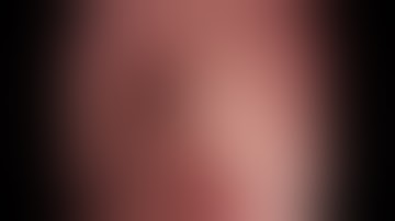 Closure of mucosal defect with a micro-ring technique: simple, cheap, and effective