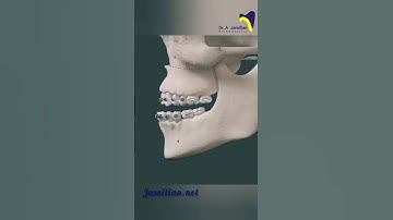 Le Fort I osteotomy for maxillary advancement #dentist#Osteotomy #orthodontist#Maxillary_Advancement