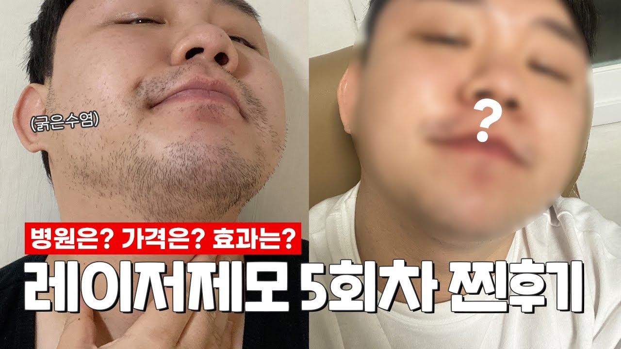 광고❌수염 레이저 제모 5회차 찐후기 (모든걸 알려드림) - Youtube