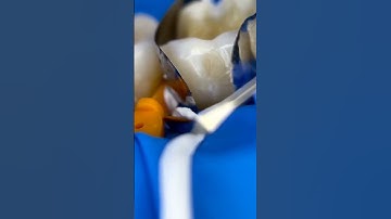 Adaptation with teflon tape.#compositerestoration #rubberdam #dentalstudents #art #cosmeticdentistry