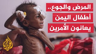 جراء سوء التغذية.. مرض التقزم المزمن يفتك بأطفال اليمن