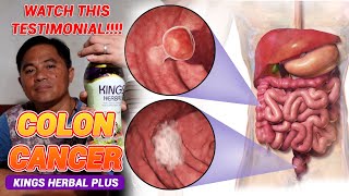 Colon Cancer - Micheael Navarro Kings Herbal Plus Testimonial Caan De Oro City